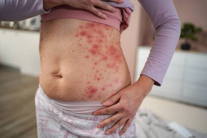 Tips for Eczema Caregivers on Daily Routines for Effective Skin Management