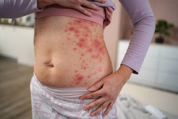 Tips for Eczema Caregivers on Daily Routines for Effective Skin Management