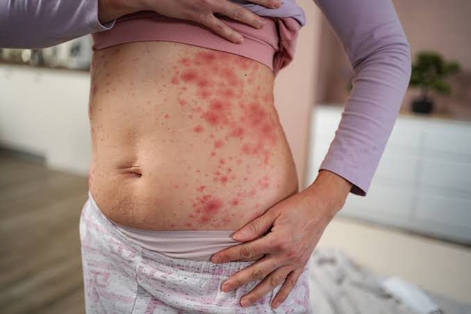 Tips for Eczema Caregivers on Daily Routines for Effective Skin Management